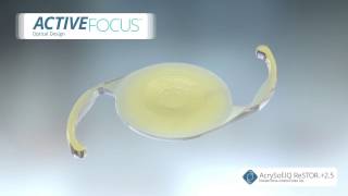 Alcon Activefocus Restor 25 Multifocal Intraocular Lens [upl. by Nayhr151]