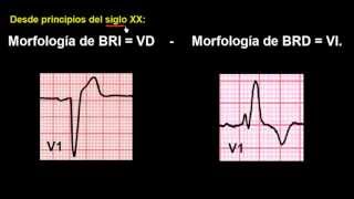 CURSO DE ELECTROCARDIOGRAFIA 48  EXTRASÍSTOLES VENTRICULARES [upl. by Aleet]