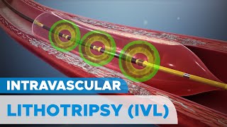 Shockwave Intravascular Lithotripsy IVL System for Severely Calcified Coronary Artery Plaques [upl. by Cinomod]