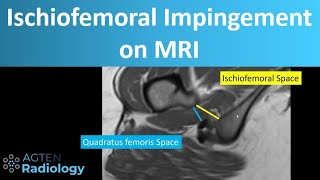 Ischiofemoral impingement on MRI [upl. by Perpetua]