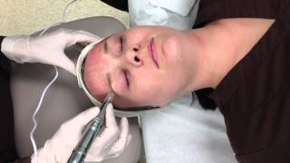 MDPen micro skin needling of the forehead [upl. by Tenaj]