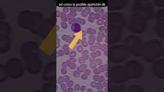 Así se ve la sangre infectada con DENGUE analisisclinicos dengue virusdeldengue [upl. by Eob752]