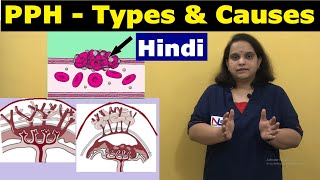 Postpartum hemorrhage in Hindi  Causes and Types of PPH  Nursing Lecture [upl. by Yhtac]