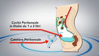 La terapia sostitutiva renale  dialisi dialisi peritoneale emodialisi  come scegliere [upl. by Niriam]