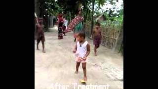 Walk For Life Clubfoot Bangladesh Happy StoryUrmi [upl. by Ayom811]