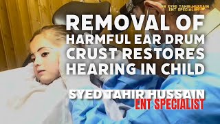 Removal of Harmful Ear Drum Crust Restores Hearing in Child  Effective Ear Treatment [upl. by Fabriane]