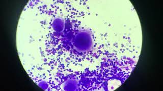 Megakaryocytes in bone marrow cytology [upl. by Navillus335]