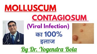 Molluscum Contagiosum ka 100 Treatment [upl. by Stoffel]