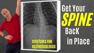 3 Corrective Exercises to Straighten Dextroscoliosis scoliosistreatment scoliosistherapy [upl. by Attayek924]