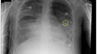 Acute Respiratory 3 ARF ARDS PE [upl. by Bolen674]