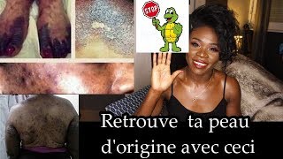 COMMENT RETROUVER RAPIDEMENT UNE BELLE PEAU APRES LA DEPIGMENTATION [upl. by Sennahoj]