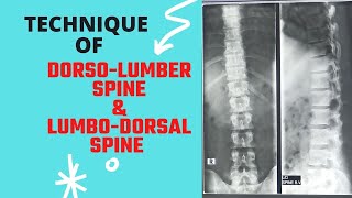 Technique of DorsoLumber amp LumboDorsal Spine Ep 65  Xray Thoracolumber spine ap amp lat views [upl. by Noslien]