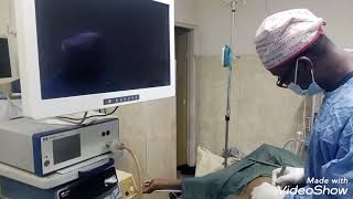 Laparoscopic Appendectomy for A Young man with Acute Appendicitis at Queens heritage hospital kano [upl. by Edison]