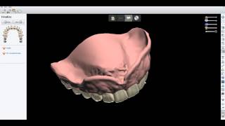 2013 3Shape Digital Denture from Kastle Mills Lee Cain Designs [upl. by Cantlon]