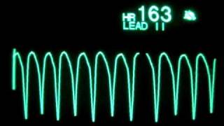 Ventricular Tachycardia [upl. by Enaira]