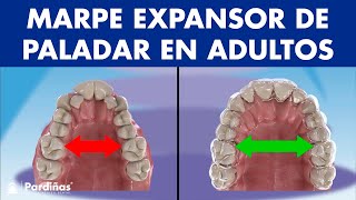 MARPE EXPANSOR de PALADAR  Así funciona el disyuntor de ortodoncia en adultos © [upl. by Atteynad581]