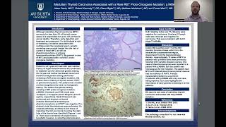 Medullary Thyroid Carcinoma Associated with a Rare RET ProtoOncogene Mutation pK666N [upl. by Engamrahc]