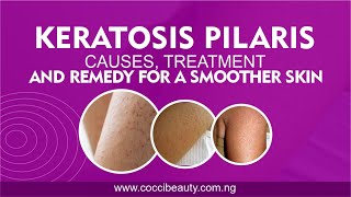 KERATOSIS PILARIS Causes Treatment and Remedy for a smoother skin [upl. by Enerual]