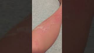 Skin Peeling from Sunburn asmr [upl. by Saddler375]