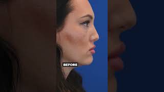 Filler Dissolving and Midface rejuvenation microneedling fattransfer fillerdissolving morpheus8 [upl. by Aratahc]