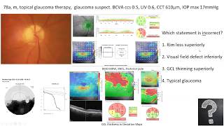 Lecture Using OCT as an Approach to Diagnose Glaucomatous and Other Optic Neuropathies [upl. by Subir]