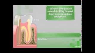 GuttaFlow2 D Root Canal Filling System [upl. by Gnuhc266]