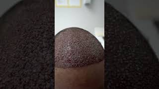 Hair Transplant procedure with 3000 grafts Before amp After  Care4Hair [upl. by Sondra592]