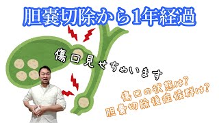 胆嚢切除 胆管石除去 急性膵炎のトリプルコンボから1年経過 今の傷口の状態など 胆嚢切除後症候群などについて [upl. by Ahtar]