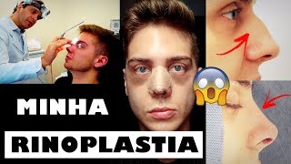 VLOG  MINHA RINOPLASTIA CIRURGIA NO NARIZ  PÓS OPERATÓRIO 24 [upl. by Llerdna85]