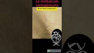 molliscum neurofibrome ndoctor rgh explorefranc [upl. by Marentic457]