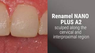 OPTIMIZING ANTERIOR ESTHETICS WITH COMPOSITE [upl. by Silenay]