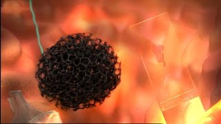 Cytosponge  Early detection for oesophageal cancer [upl. by Atiuqrehs]