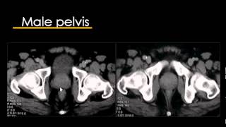 CT Abdomen Arabic  Prof Mamdouh Mahfouz [upl. by Netti]