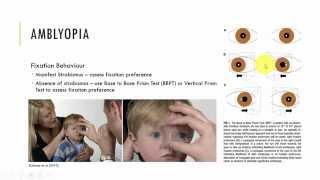 Amblyopia Diagnosis [upl. by Esserac786]