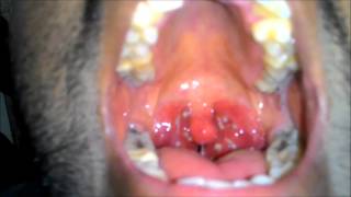 Acute Tonsillitis with Tonsillar exudates [upl. by Donielle]