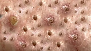 Amazing Blackheads Remover on the Face 021 [upl. by Sigismund]