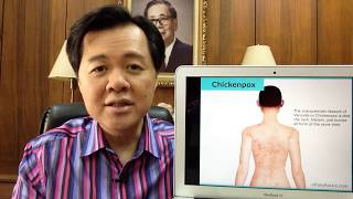 Chicken Pox o Bulutong Tubig  Payo ni Dr Willie Ong 100 [upl. by Siskind]