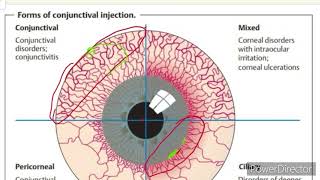 Conjunctiva  Red eye  Conjunctival and Ciliary Congestion  Ophthalmology [upl. by Nachison]