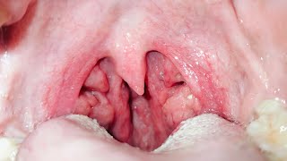 Tonsil Stones Removal from Deep Tonsil Crepts [upl. by Idihsar]