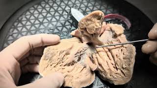 Specimen walkthrough 11 Double inlet left ventricle Cardiac anatomy cardiac pathology [upl. by Latnahc]