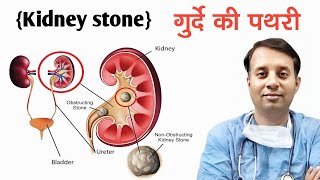 KidneyBladderProstaticUreteric Stone  Turp  turbt vvf  Dr Arawat Pushkarna  H R Talib Hussain [upl. by Nonah511]