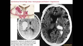 72 Hemorrhagic stroke hypertensive haemorrhage lobar haemorrhage swirl black hole spot sign [upl. by Asiak884]