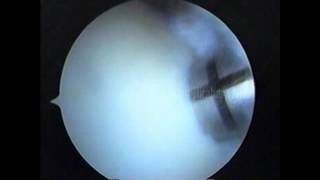 Knee arthroscopy  OCD Mosaicplasty [upl. by Eenoj]