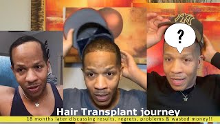 18 months Hair Transplant update SCARY results side effects regret wasted money amp renewed mind [upl. by Ursal]