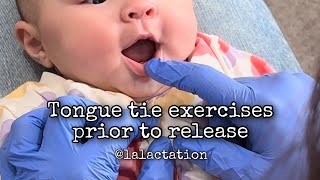 Infant tongue exercises prior to tongue and lip tie release [upl. by Robaina]