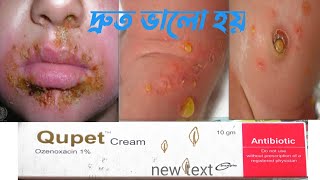 Qupet creamquotimpetigo disease“মুখের বিভিন্ন জায়গায় ফুসকুড়ি ভালো হয়ে যাবে quotMedicare Watch 24 [upl. by Ursal]