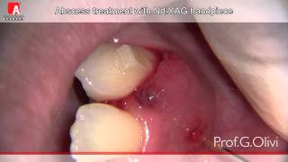 ABSCESS TREATMENT Fotona Lightwalker NdYAG laser [upl. by Natsrik]