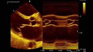 Insuffisance mitrale Sévère par rupture de cordagequotMitral Prolapsequot القصور التاجي الحاد [upl. by Rame501]