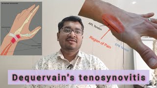 कलाई में दर्द  Dequervains tenosynovitis in Hindwrist thumb painTenosynovitis treatment video [upl. by Leone]