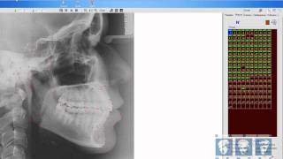 Manuseando Ferramentas da Cefalometria [upl. by Elirpa778]